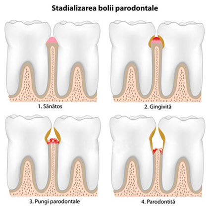 Stadiile bolii paradontale